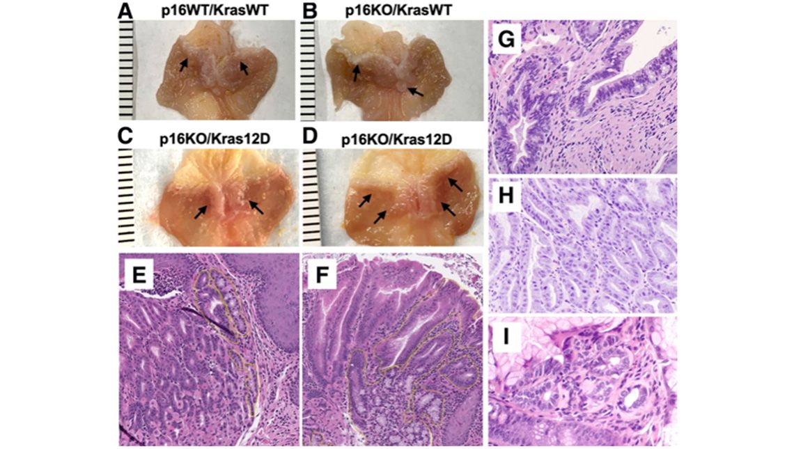 Oncogenic KRAS and loss of p16 together