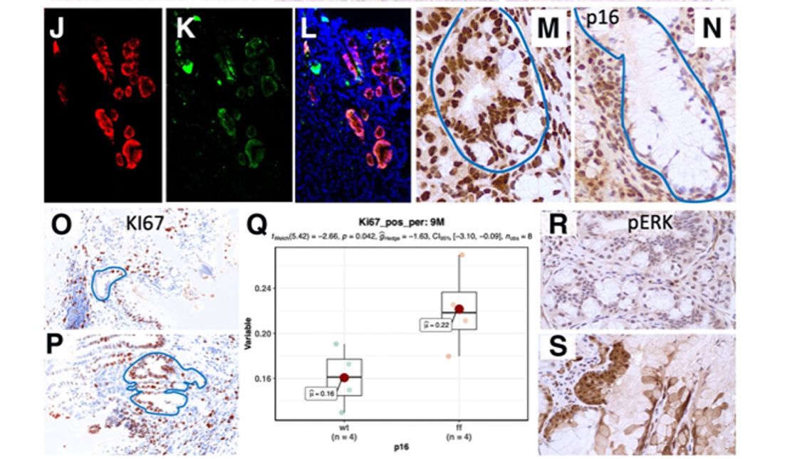Oncogenic KRAS and loss of p16 together LGR5+ progenitor cells